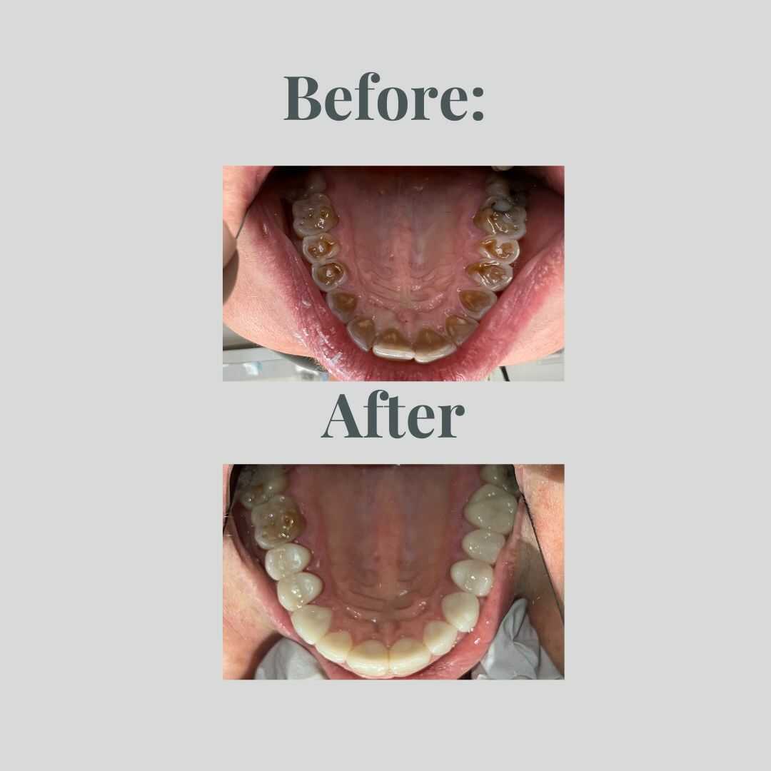 Smile transformation result