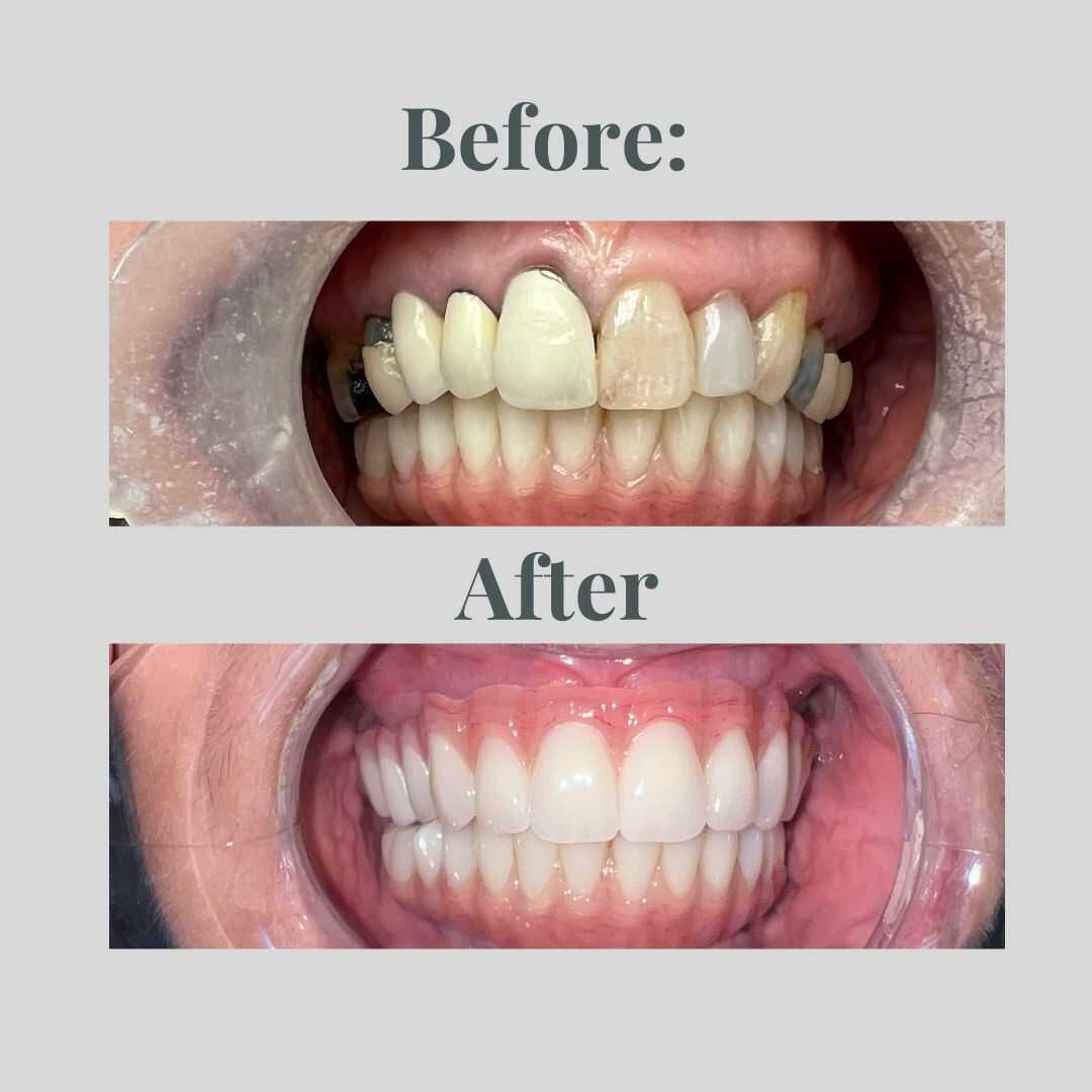 Smile transformation result