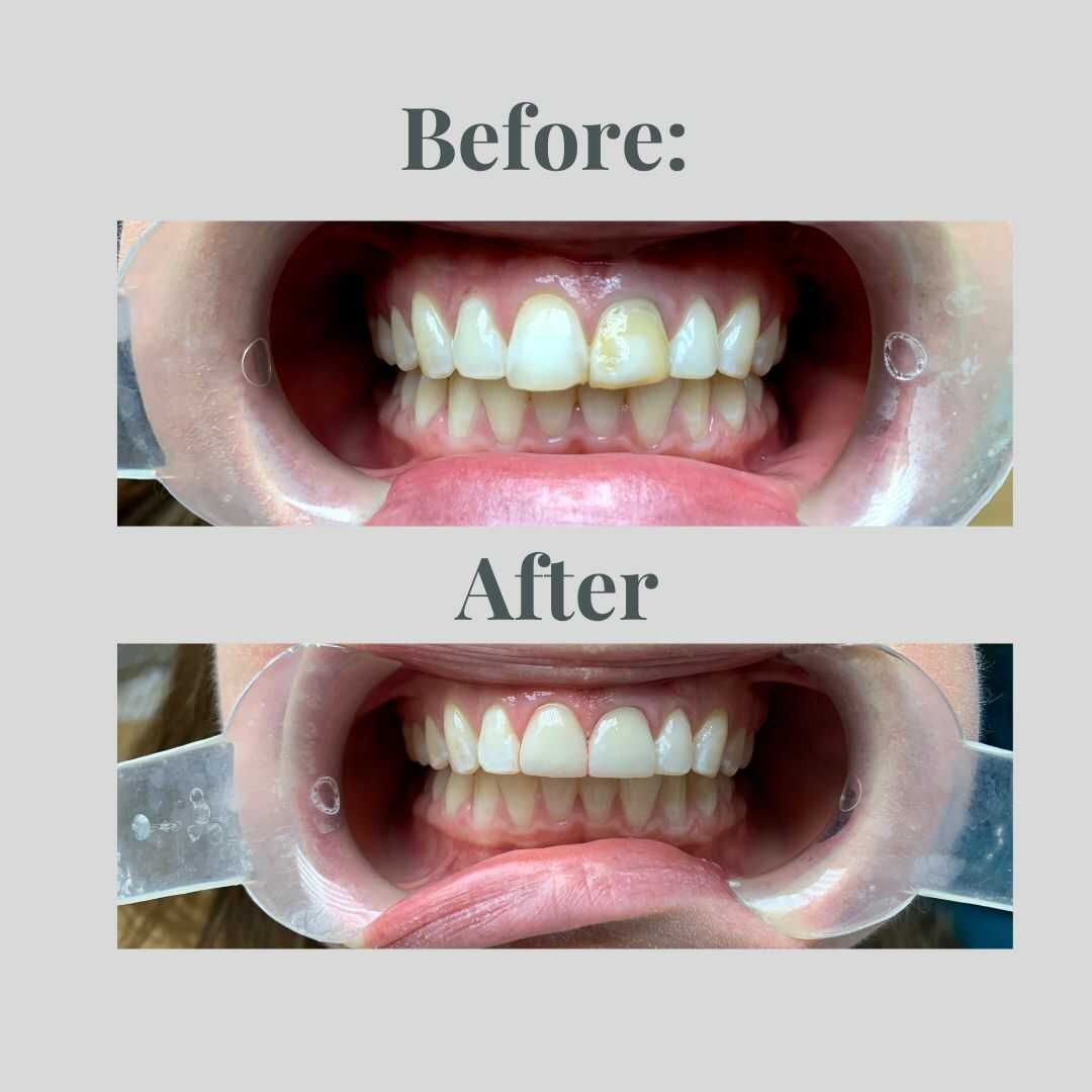 Smile transformation result