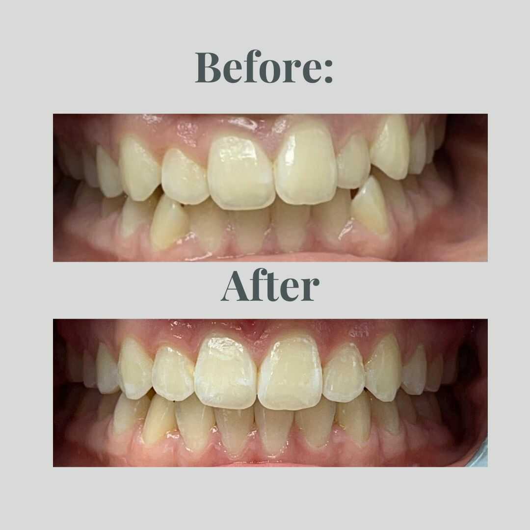 Smile transformation result