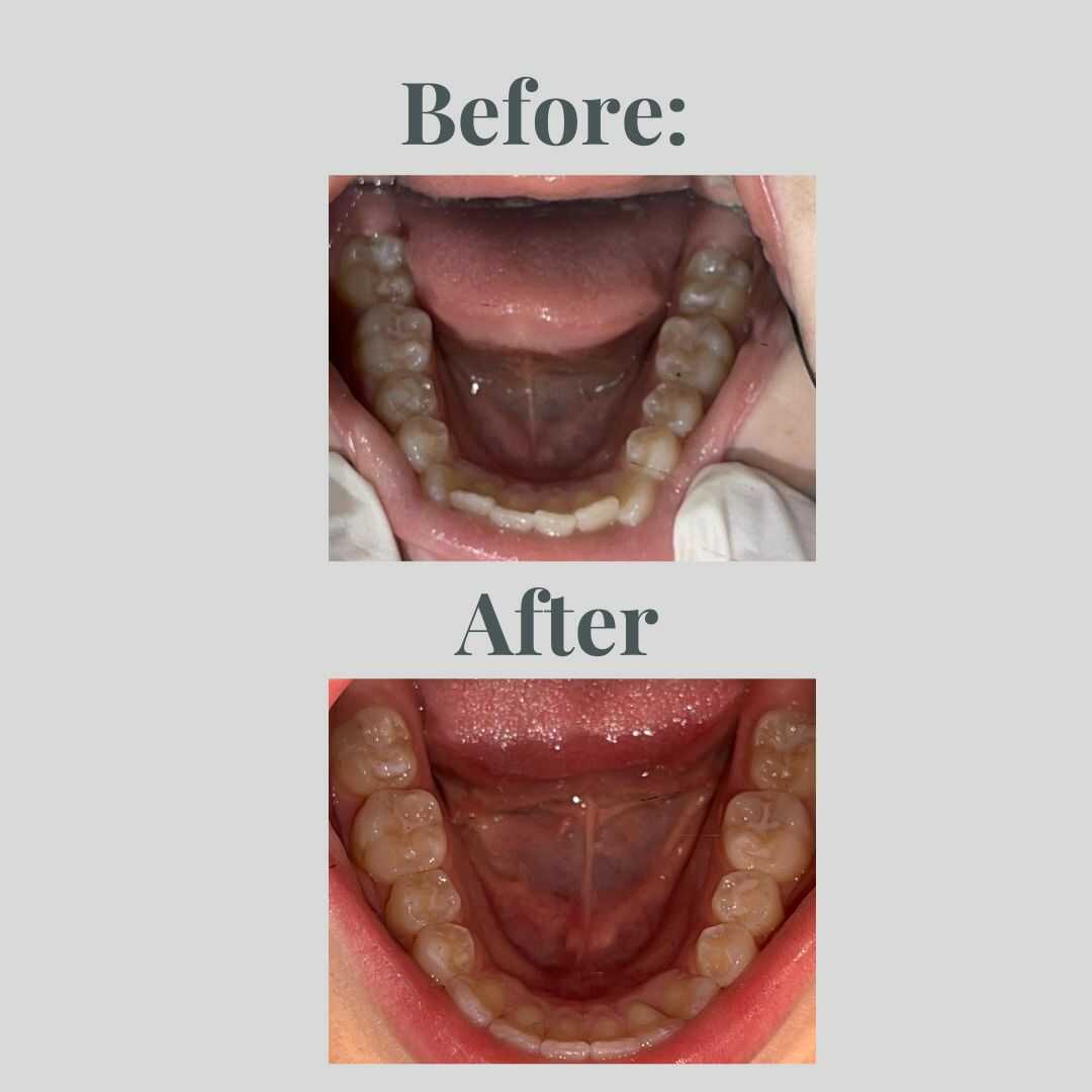 Smile transformation result