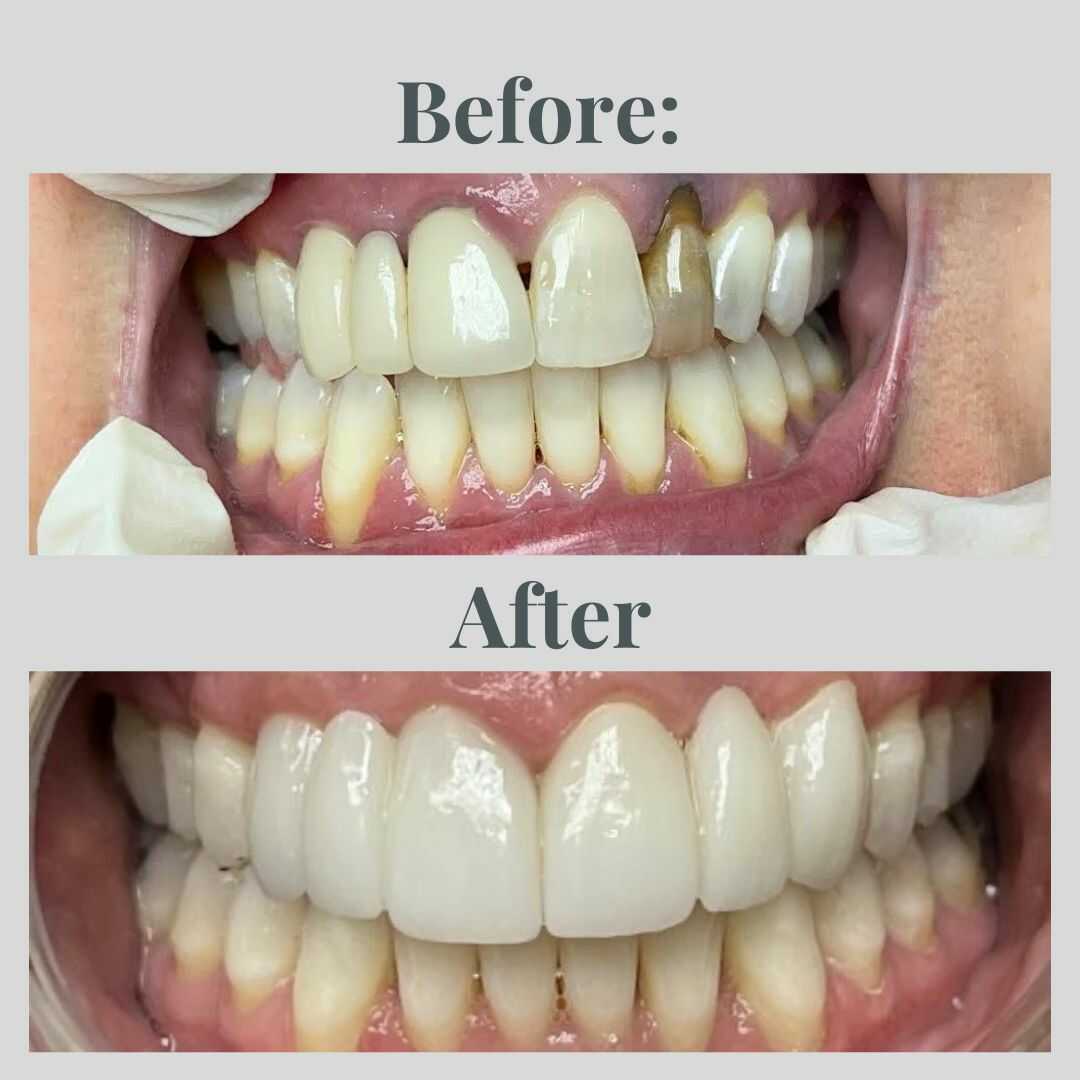 Smile transformation result