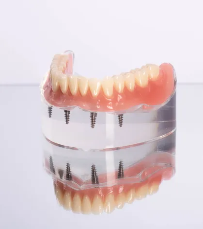 Dental implants at Sunrise Dental Studio near Glen Burnie, MD