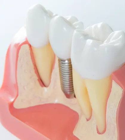 Dental implants at Sunrise Dental Studio near Severna Park, MD