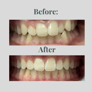 Before and After Treatment 5